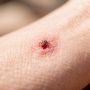 Керчане этим летом в два раза чаще обращаются в больницу с укусами клещей